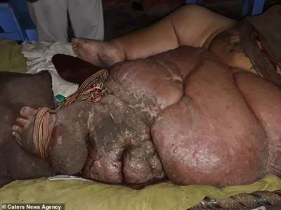 Пакистанец умоляет врачей отрезать ему ногу весом 150 кг